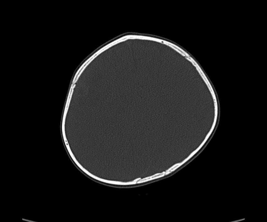 Acute hemorrhagic contusion (Radiopaedia 63660-72336 Axial bone window 50).jpg