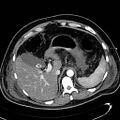 Acute pancreatic necrosis (Radiopaedia 13560-13486 Axial C+ portal venous phase 38).jpg