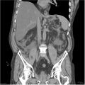 Acute pancreatitis (Radiopaedia 19135-19116 Coronal non-contrast 26).jpg