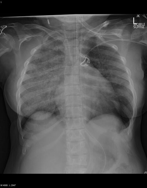 File:Acute pulmonary edema, mitral regurgitation and mucopolysaccharidosis (Radiopaedia 56239).jpg
