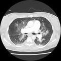 Acute pulmonary edema on CT (Radiopaedia 33582-34672 Axial lung window 22).jpg