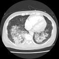 Acute pulmonary edema on CT (Radiopaedia 33582-34672 Axial lung window 38).jpg