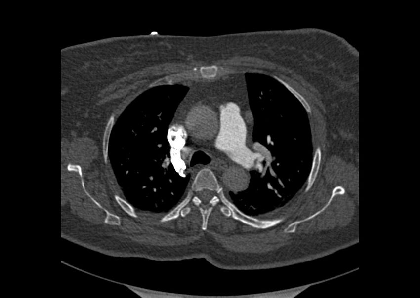 Acute pulmonary embolism (Radiopaedia 29938-30466 Axial C+ CTPA 25).jpg