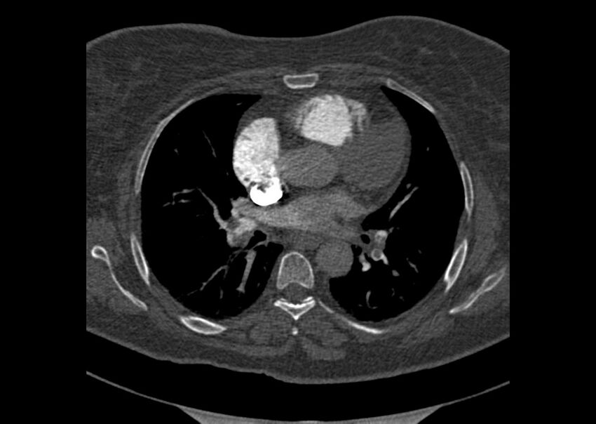 Acute pulmonary embolism (Radiopaedia 29938-30466 Axial C+ CTPA 93).jpg