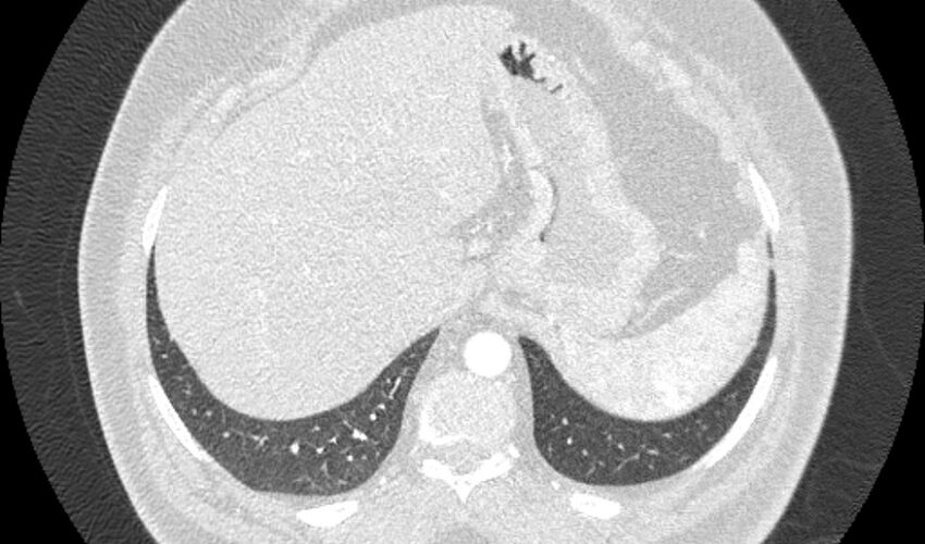Acute pulmonary embolism with pulmonary infarcts (Radiopaedia 77688-89908 Axial lung window 121).jpg