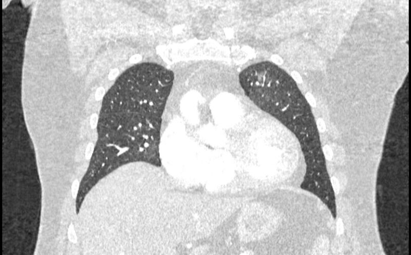 File:Acute pulmonary embolism with pulmonary infarcts (Radiopaedia 77688-89908 Coronal lung window 20).jpg