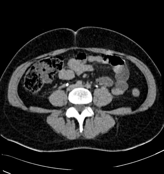 File:Acute pyelonephritis (Radiopaedia 40264-42816 Axial renal excretory phase 21).jpg