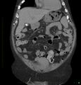 Acute renal failure post IV contrast injection- CT findings (Radiopaedia 47815-52557 Coronal non-contrast 10).jpg