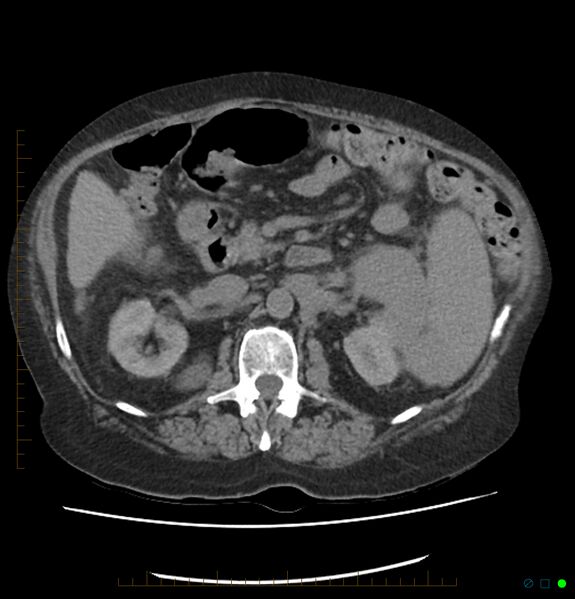 File:Acute renal failure post IV contrast injection- CT findings (Radiopaedia 47815-52559 Axial C+ portal venous phase 32).jpg