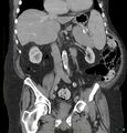 Acute renal failure post IV contrast injection- CT findings (Radiopaedia 47815-52559 Coronal C+ portal venous phase 14).jpg