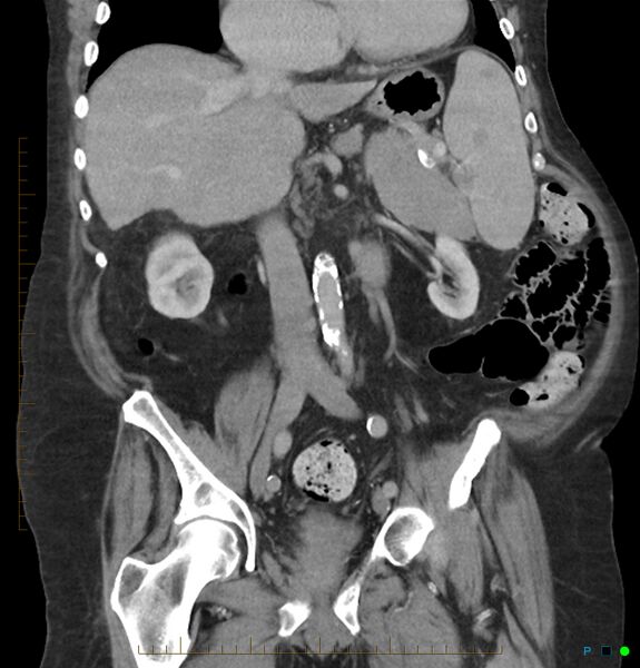 File:Acute renal failure post IV contrast injection- CT findings (Radiopaedia 47815-52559 Coronal C+ portal venous phase 14).jpg