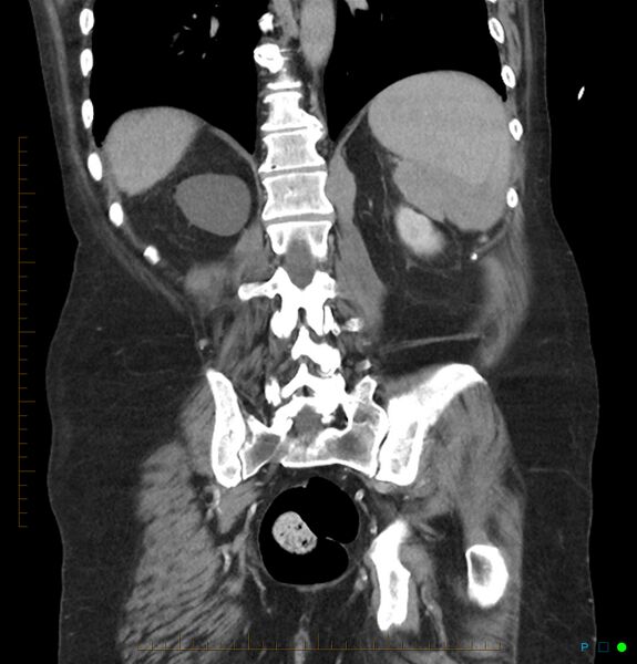 File:Acute renal failure post IV contrast injection- CT findings (Radiopaedia 47815-52559 Coronal C+ portal venous phase 27).jpg