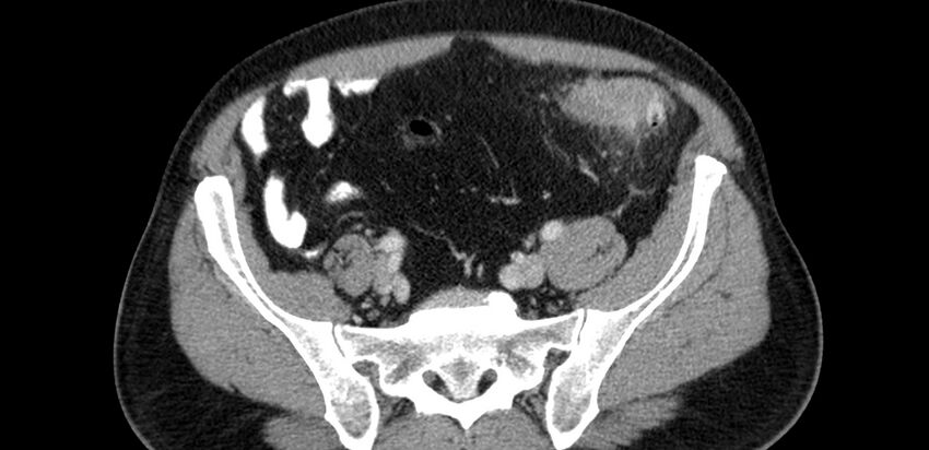 Acute sigmoid colon diverticulitis (Radiopaedia 55507-61976 Axial C+ portal venous phase 72).jpg