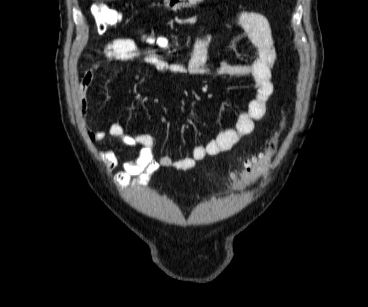 File:Acute sigmoid colon diverticulitis (Radiopaedia 55507-61976 Coronal C+ portal venous phase 11).jpg
