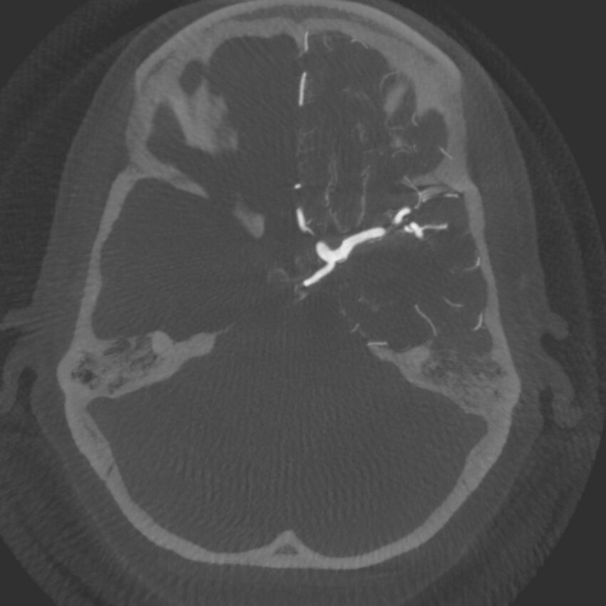 Acute subarachnoid hemorrhage and accessory anterior cerebral artery (Radiopaedia 69231-79010 C 20).jpg