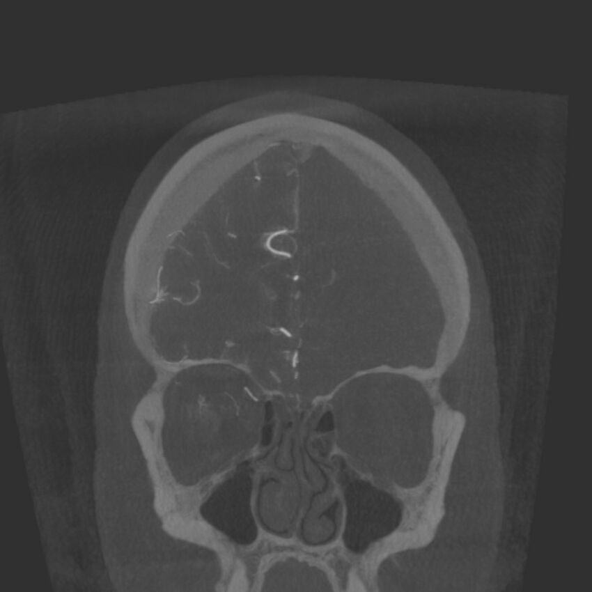 Acute subarachnoid hemorrhage and accessory anterior cerebral artery (Radiopaedia 69231-79010 Coronal arterial - MIP 20).jpg