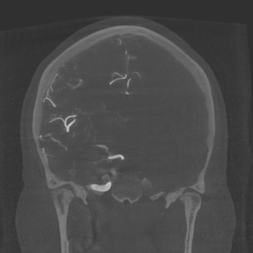 Acute subarachnoid hemorrhage and accessory anterior cerebral artery (Radiopaedia 69231-79010 Coronal arterial - MIP 53).jpg