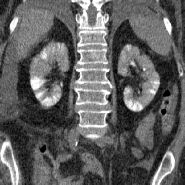 File:Acute tubular necrosis (Radiopaedia 28077-28334 Coronal non-contrast 17).jpg