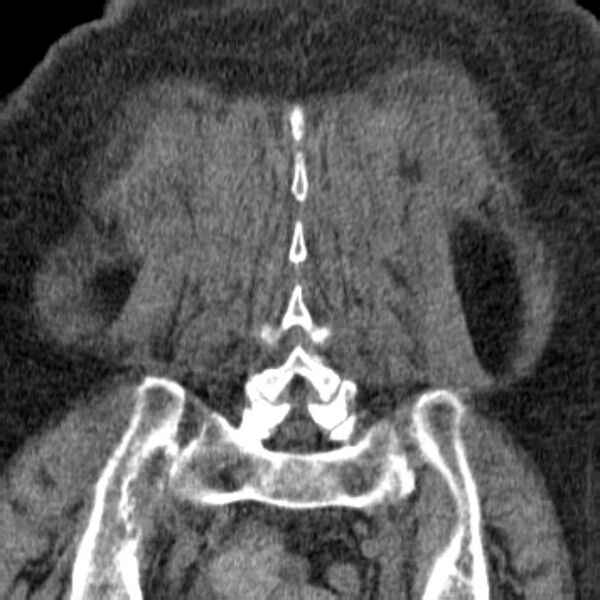 File:Acute tubular necrosis (Radiopaedia 28077-28334 Coronal non-contrast 36).jpg