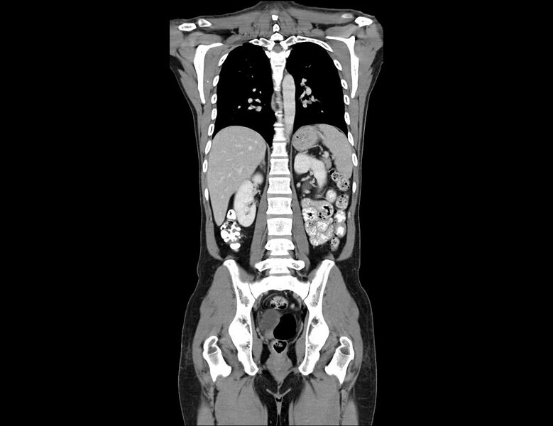File:Addison disease (Radiopaedia 49318-54412 Coronal C+ portal venous phase 15).jpg