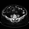 Adenocarcinoma of the appendix (Radiopaedia 31023).jpg