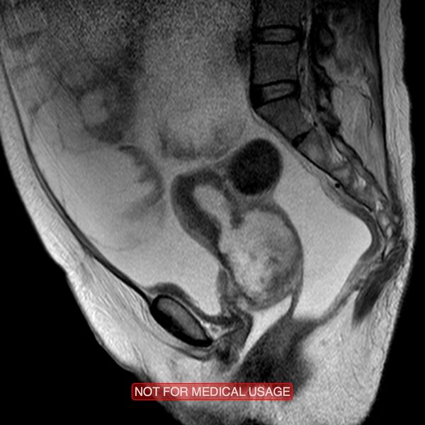 File:Adenocarcinoma of the cervix (Radiopaedia 28373-28615 Sagittal T2 9).jpg