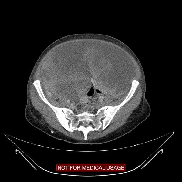 File:Adenocarcinoma of the cervix (Radiopaedia 28373-28616 Axial C+ portal venous phase 14).jpg