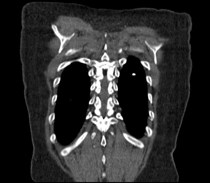 File:Adenocarcinoma of the lung (Radiopaedia 44205-47803 Coronal C+ portal venous phase 89).jpg