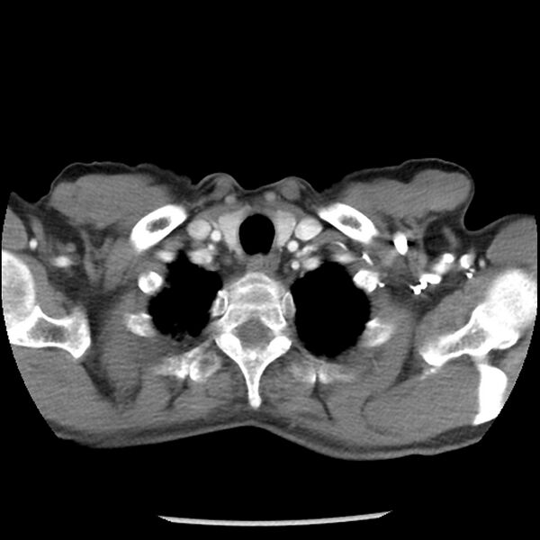 File:Adenocarcinoma of the lung - micropapillary predominant (Radiopaedia 42446-45563 Axial C+ portal venous phase 5).jpg
