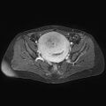 Adenomyoma of the uterus (huge) (Radiopaedia 9870-10438 Axial T1 C+ fat sat 18).jpg