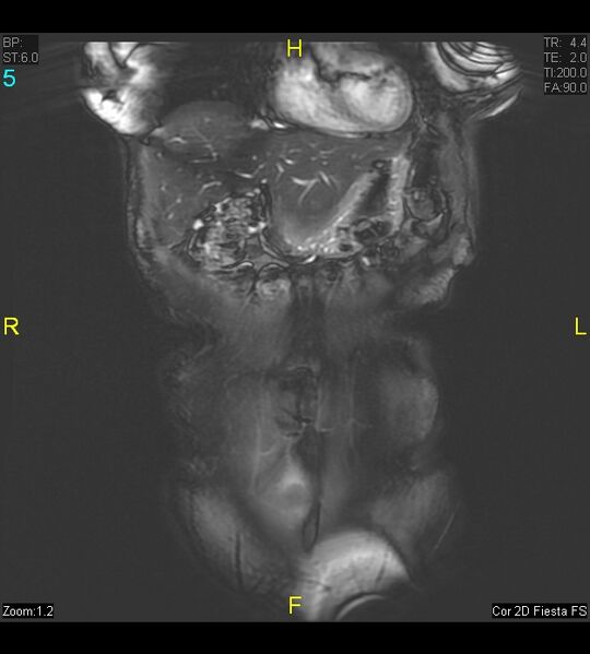File:Adenomyosis (Radiopaedia 43504-46889 Coronal 2D FIESTA 5).jpg