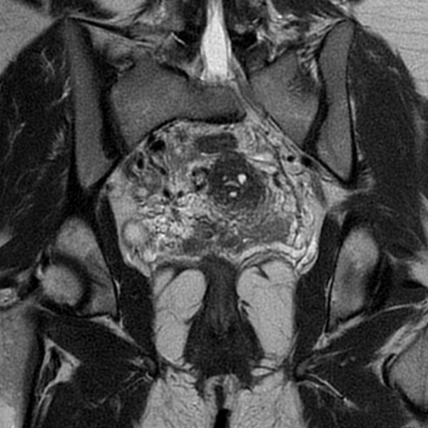 File:Adenomyosis within a septate uterus (Radiopaedia 69963-79981 Coronal T2 21).jpg