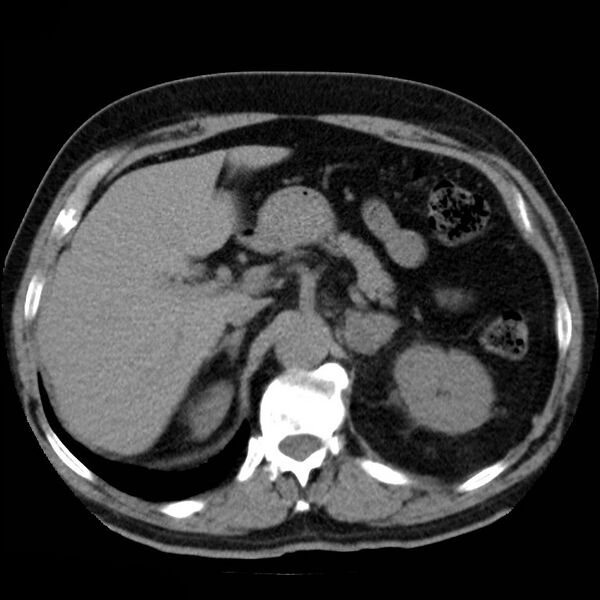 File:Adrenal hemangioma (Radiopaedia 11039-11445 Axial non-contrast 5).jpg
