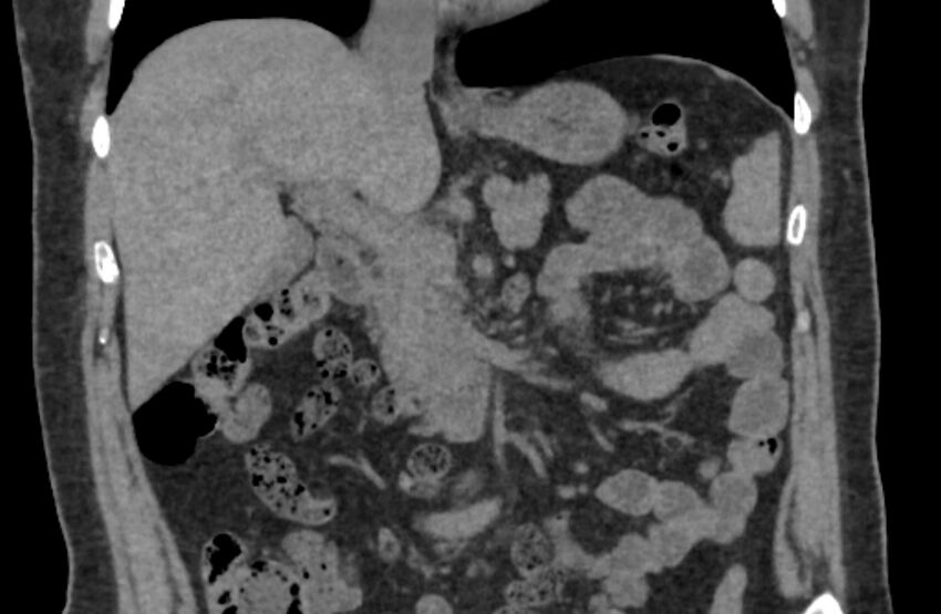 Adrenal myelolipoma (Radiopaedia 65240-74253 Coronal non-contrast 1).jpg