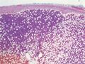Adrenal myelolipoma (pathology) (Radiopaedia 19001-18961 20x H&E 1).jpg