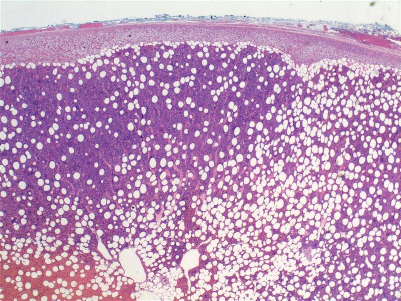 File:Adrenal myelolipoma (pathology) (Radiopaedia 19001-18961 20x H&E 1).jpg