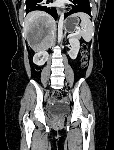 File:Adrenocortical carcinoma (Radiopaedia 87281-103569 Coronal C+ portal venous phase 70).jpg