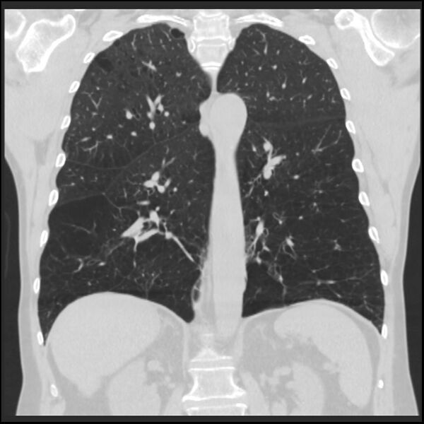 File:Alpha-1-antitrypsin deficiency (Radiopaedia 40993-43722 Coronal lung window 66).jpg