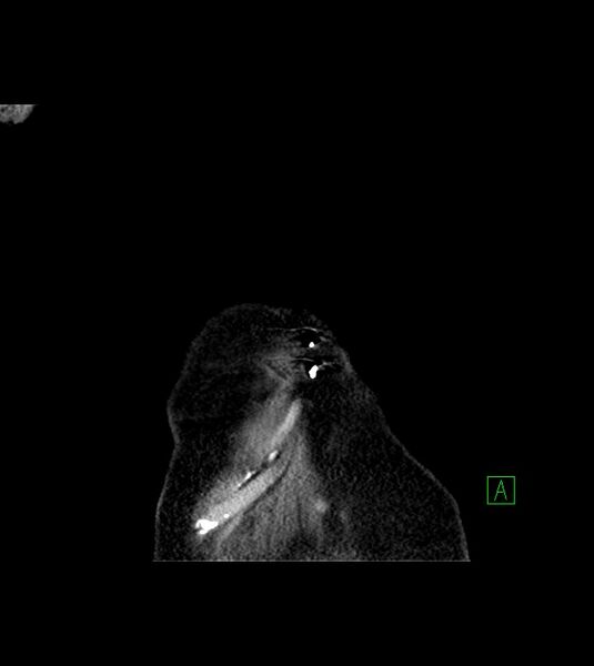 File:Amiodarone deposition in the liver (Radiopaedia 77587-89780 Coronal non-contrast 8).jpg