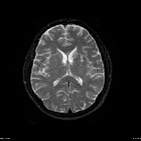 File:Amnestic syndrome secondary to hypoxic brain injury (Radiopaedia 24743-25004 DWI 50).jpg