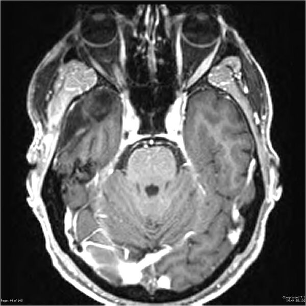 File:Anaplastic meningioma with recurrence (Radiopaedia 34452-35788 Axial T1 C+ 44).jpg