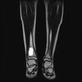 Aneurysmal bone cyst - tibia (Radiopaedia 22343-22367 Coronal T2 8).jpg