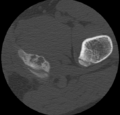 Aneurysmal bone cyst of ischium (Radiopaedia 25957-26094 B 52).png