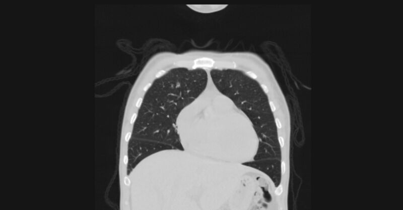 File:Angioinvasive aspergellosis (Radiopaedia 66995-76315 Coronal lung window 15).jpg