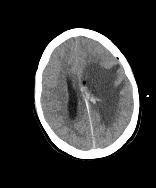 File:Angiomatous meningioma (Radiopaedia 79459-92578 Axial non-contrast 20).jpg