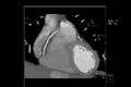 Anomalous right coronary artery (ARCA) with interarterial course (Radiopaedia 12423-12677 C 7).jpg