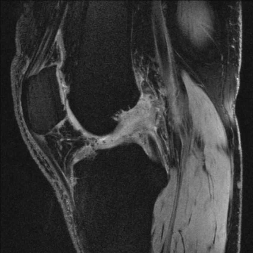 Anterior cruciate ligament mucoid degeneration (Radiopaedia 68400-77933 Sagittal 33).jpg