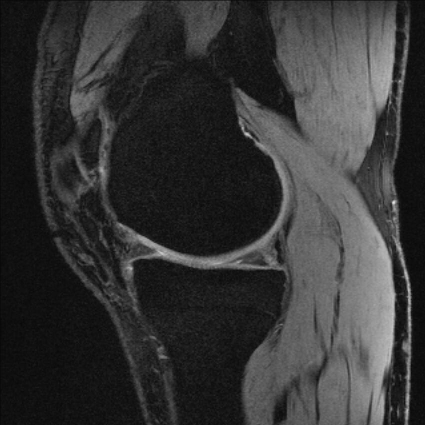 Anterior cruciate ligament mucoid degeneration (Radiopaedia 68400-77933 Sagittal 45).jpg
