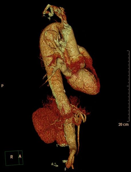 File:Aortic aneurysm and penetrating ulcer (Radiopaedia 23590-23704 3D reconstruction 7).jpg