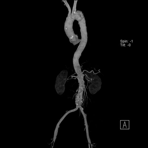 File:Aortic arch saccular aneurysm (Radiopaedia 19430-19457 A 1).jpg